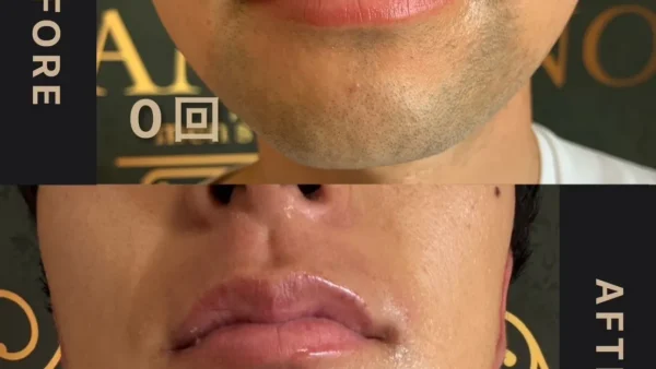 【BEFORE→AFTER】ヒゲ脱毛の常識を覆す！ダメリーノだけの圧倒的変化